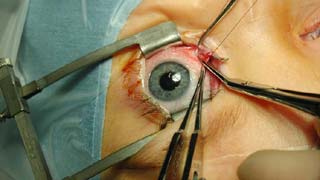 Ophthalmology Treatment Cost in Germany