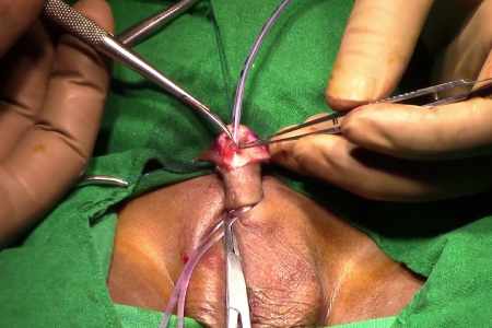 Hypospadias Surgery Treatment Cost 