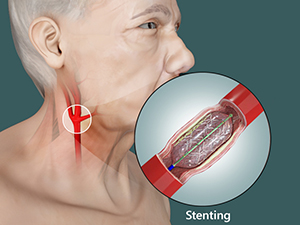 Carotid Stenting Surgery Treatment Cost 