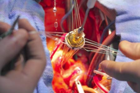 Heart Valve Replacement Treatment Cost 