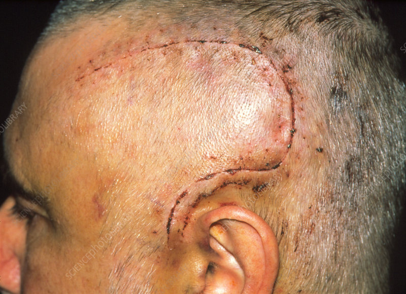 Craniotomy Treatment Cost 