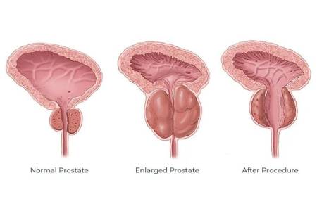 Prostate Surgery Treatment Cost 