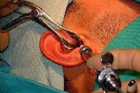 Stapedectomy Surgery Treatment Cost 
