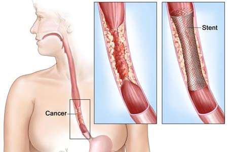 Esophageal Cancer Treatment Treatment Cost 