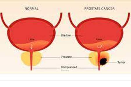 Prostate Cancer Treatment Treatment Cost 