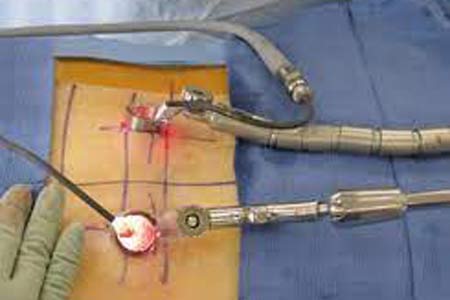 Minimally Invasive Spine Surgery Treatment Cost 