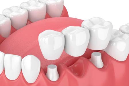 dental crown treatment types