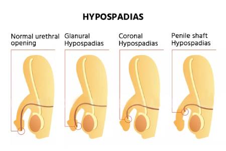 Cost of Hypospadias Surgery India