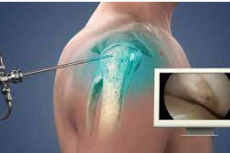 Shoulder Dislocation Surgery side effects