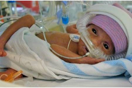 Affordable Cost of Hydrocephalus Surgery in India