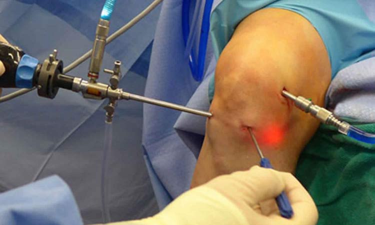 Knee Arthroscopy Cost in India