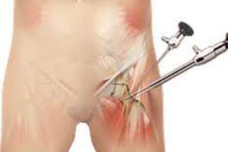 Hip Arthroscopy before and after