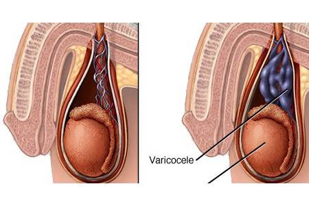 Low Cost Varicocelectomy in India