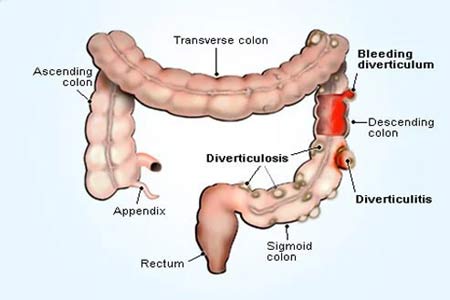 Diverticulitis Treatment Side Effects