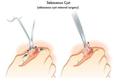 Sebaceous Cyst Removal Surgery Purpose