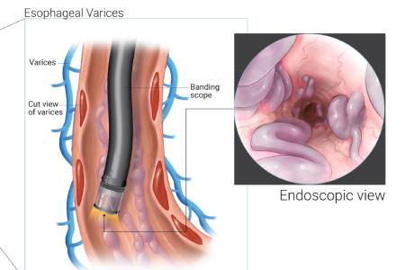 Affordable Cost for Esophageal Varices Treatment