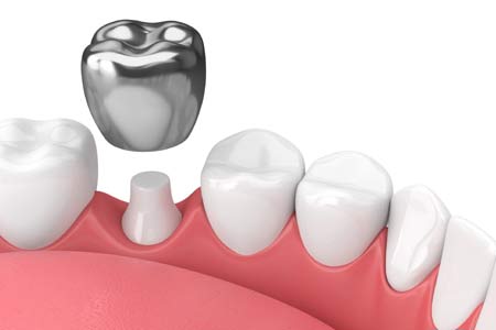 Dental Crown Treatment in India