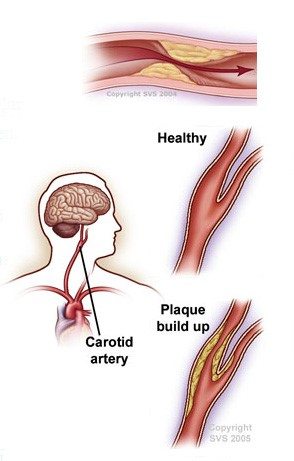 Carotid stenting for restoring normal blood flow
