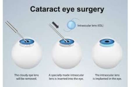 Affordable Cost for Cataract Surgery