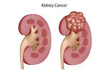 kidney cancer treatment side effects