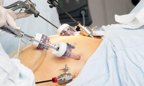 Affordable cost of laparoscopic surgery in india