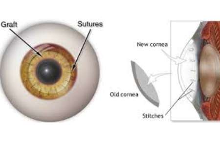 Affordable Corneal Transplant Cost in India
