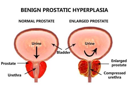 Cost of Benign Prostatic Hyperplasia Surgery in India