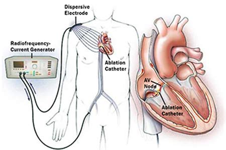 Cardiac ablation causes