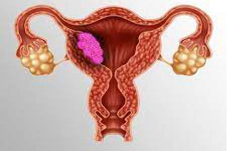 uterine cancer treatment side effects