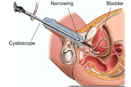 Cystolithotripsy Surgery in India