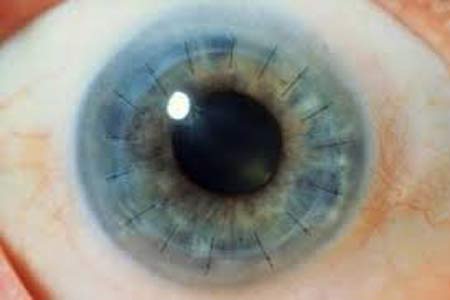 corneal transplant before and after