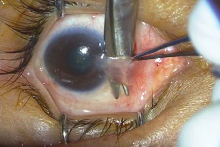 Pterygium Surgery Side Effects
