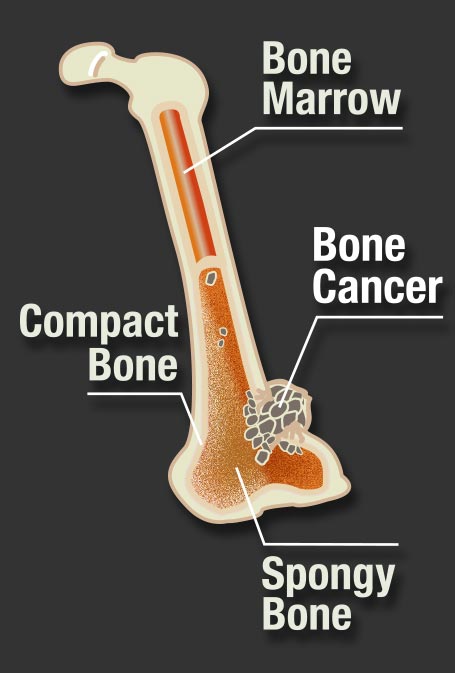 Reasonably priced bone cancer treatment