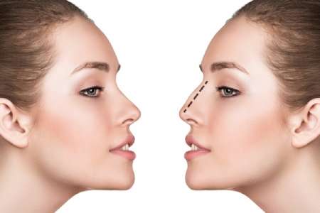 Low Cost Septoplasty Surgery 