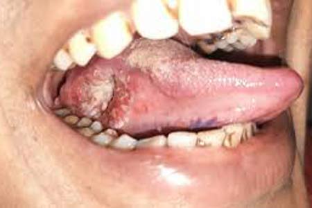 mouth cancer treatment before and after