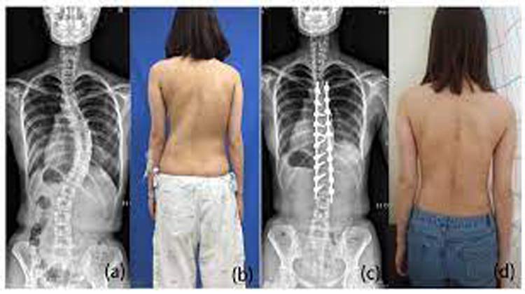 Scoliosis Surgery in India