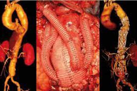 aortic aneurysm surgery types