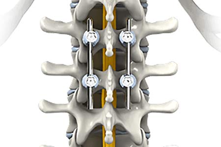 spinal fusion surgery side efects