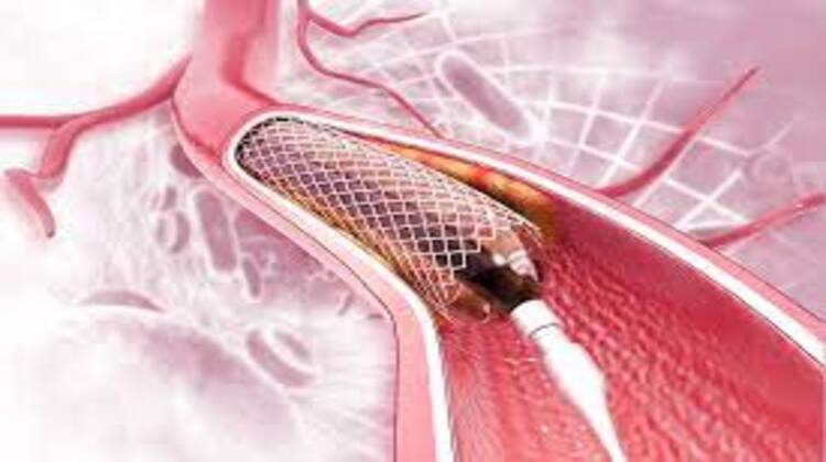 Angioplasty Cost in India