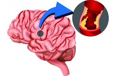 Affordable treatment of brain stroke