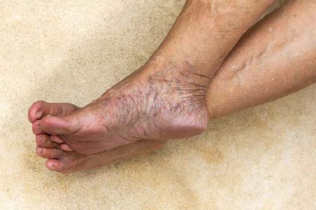 varicose veins surgery in India