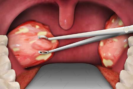tonsillectomy surgery side effects