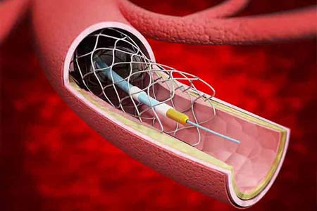 angioplasty before and after