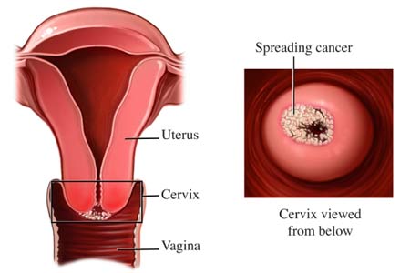 Cost of Treatment for Cervical Cancer in India