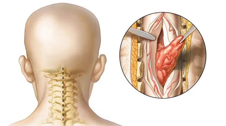Spine Tumor Surgery in India