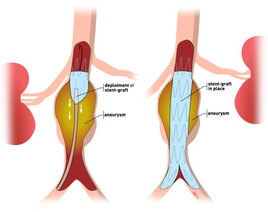 Illustration of a stent graft used in abdominal aortic aneurysm repair