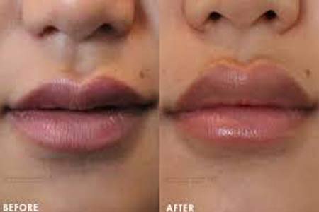 lip augmentation types