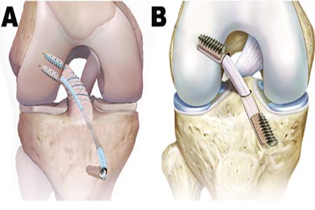 acl reconstruction types