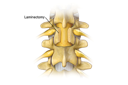 Low Cost Laminectomy Surgery in India