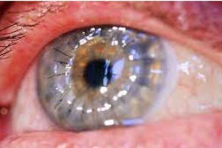 Low Cost Corneal Transplant in India